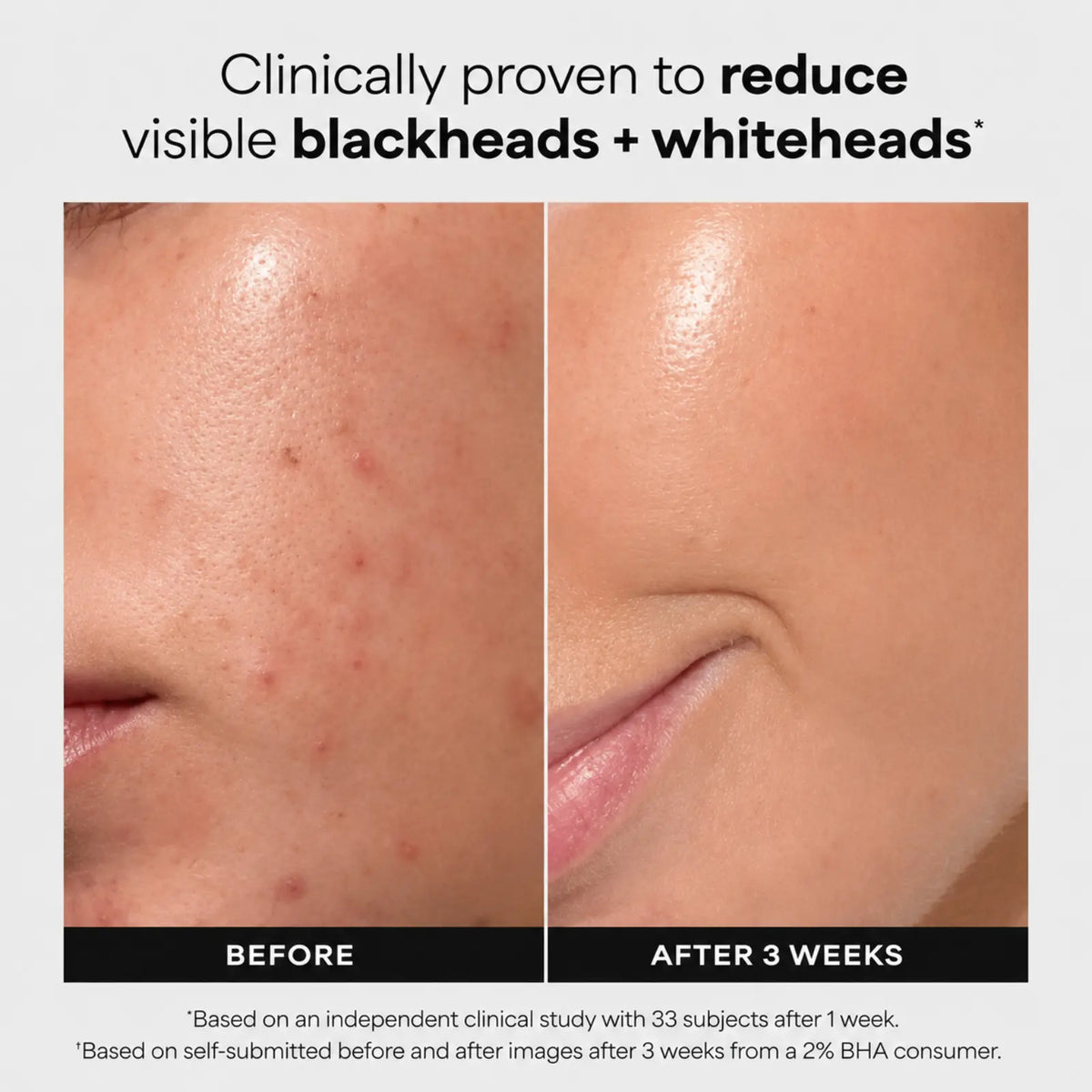 Paula's Choice Skin Perfecting 2% BHA Liquid Exfoliant